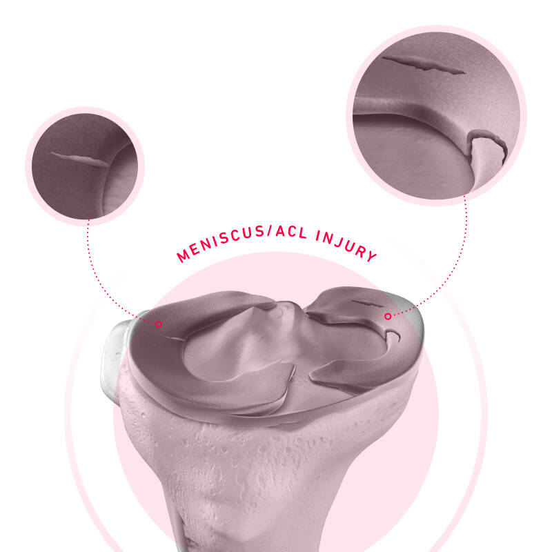 Rappresentazione schematica di una lacrima meniscale su un modello dell'articolazione del ginocchio