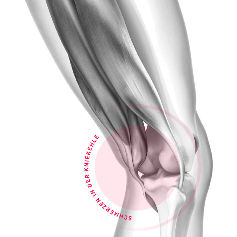 Rappresentazione schematica Dolore nella parte posteriore del ginocchio
