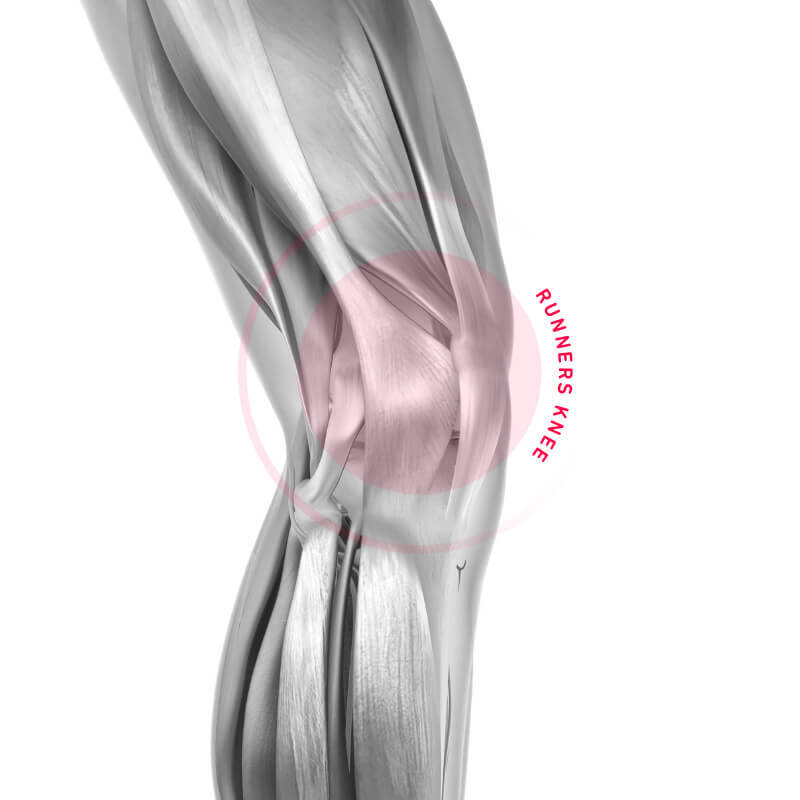 Runners Knee (ITBS) come causa del dolore al ginocchio durante la corsa Rappresentazione schematica dell'area dolorante con un ginocchio
