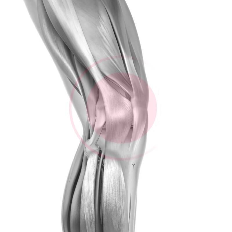 Runners Knee (ITBS) come causa del dolore al ginocchio durante la corsa Rappresentazione schematica dell'area dolorante con un ginocchio