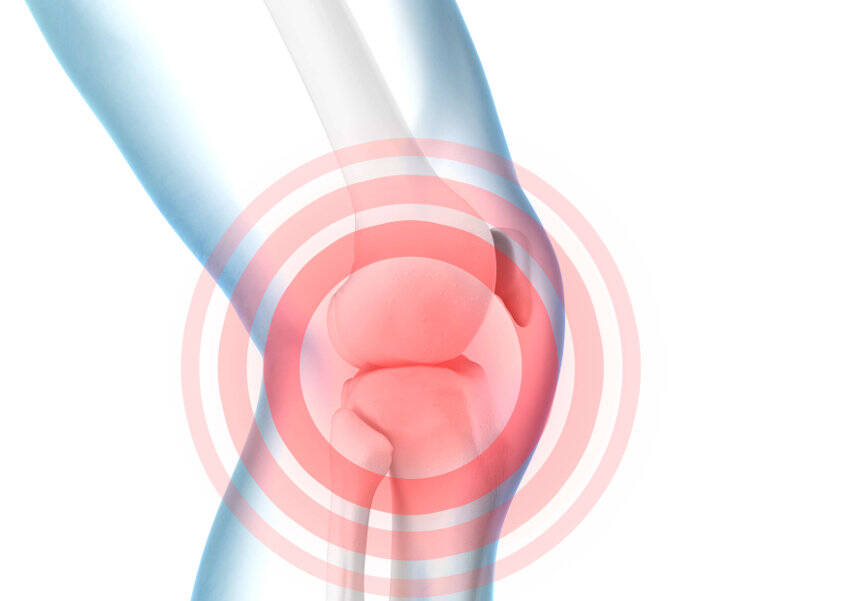 Rappresentazione schematica del dolore al ginocchio su un modello dell'articolazione del ginocchio